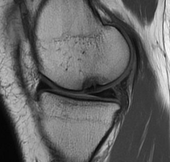Mosaicplasty MRI Post Implantation Sagittal Good Cartilage Cover